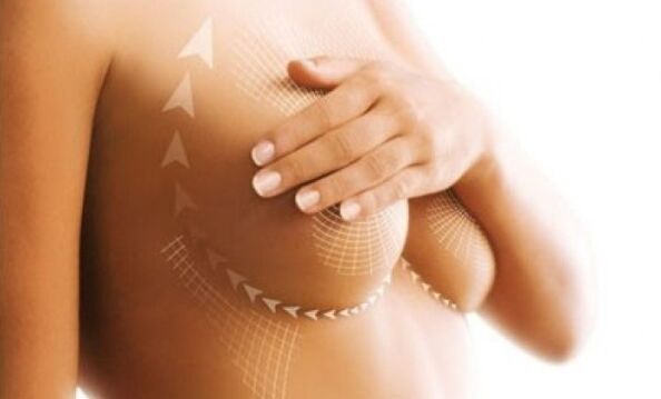 Breast augmentation suture lifting