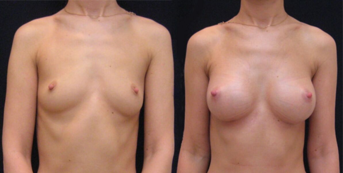 Breast before and after endoscopic breast augmentation