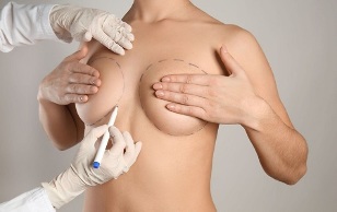 Breast augmentation surgery method