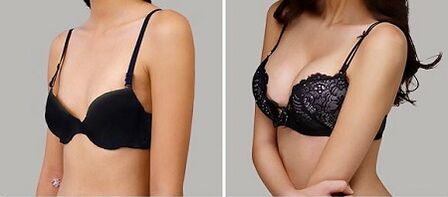 Photos before and after breast augmentation