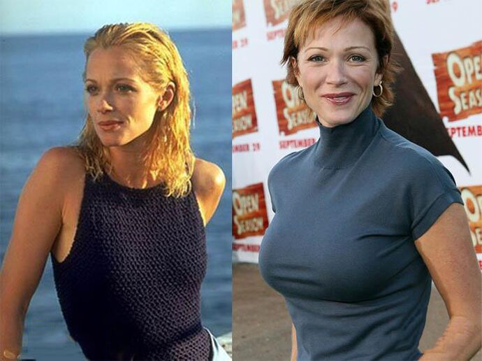 Before and after breast swelling