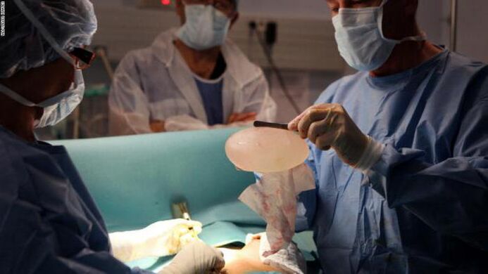 Characteristics of mammoplasty