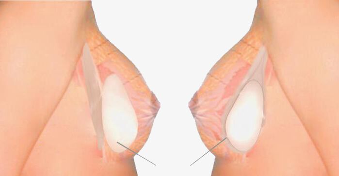 What is breast papilloplasty