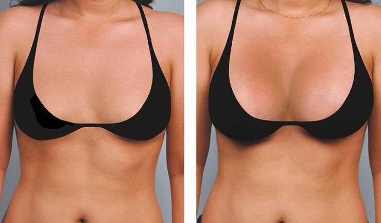 Breast augmentation before and after photos