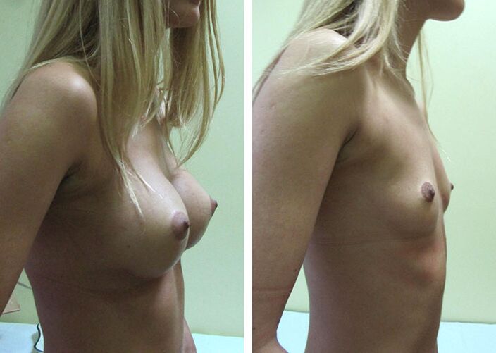Breast augmentation results
