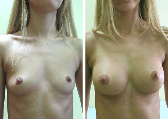 Breasts before and after breast augmentation