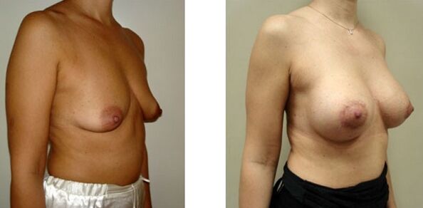 Before and after breast augmentation