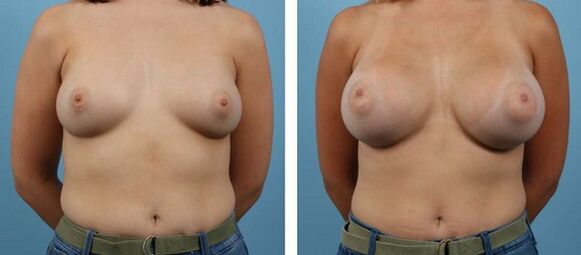Breast augmentation before and after photos