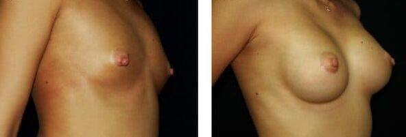 Breast augmentation before and after