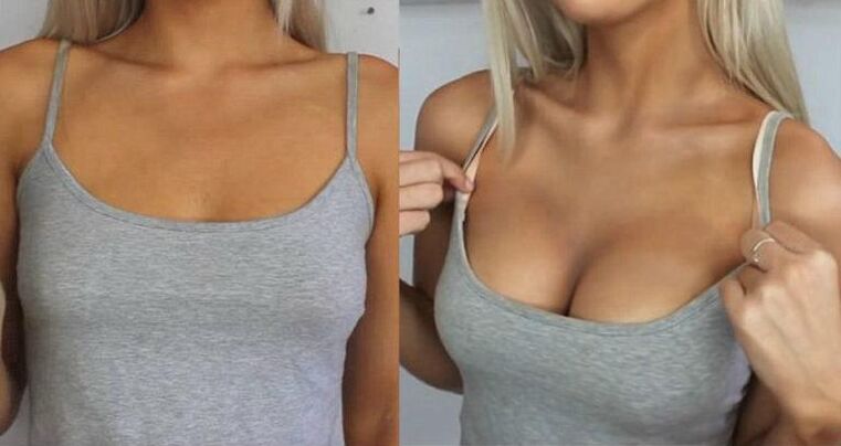 Breast augmentation before and after