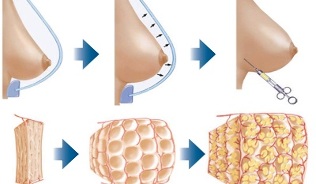 How to use fat for breast augmentation