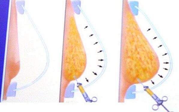 Breast enlargement contains fat