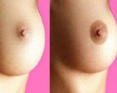 Before and after nipple augmentation surgery