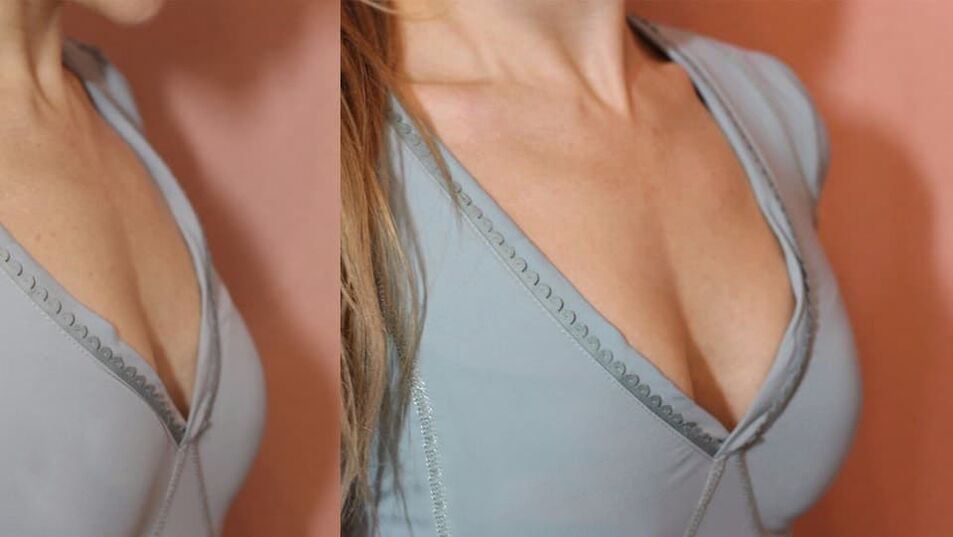Before and after using breast enhancement products