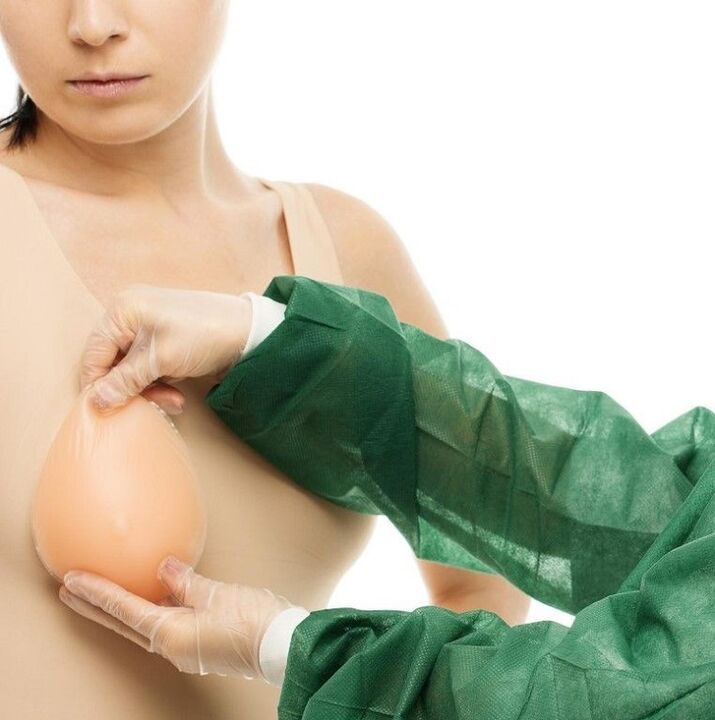 Breast augmentation implants