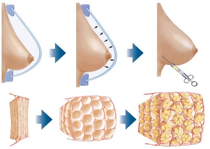 Breast augmentation surgery methods