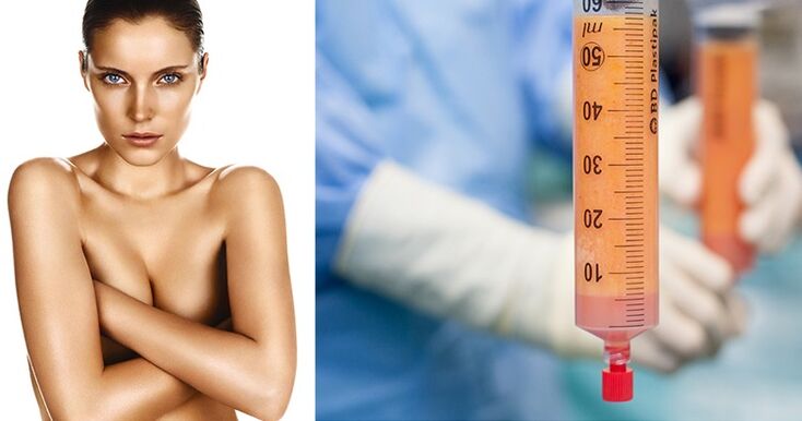 Fat filling as a breast augmentation method