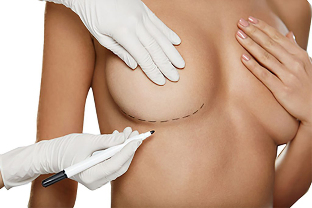 Mark with a marker before breast augmentation surgery