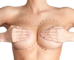 Breast enhancement